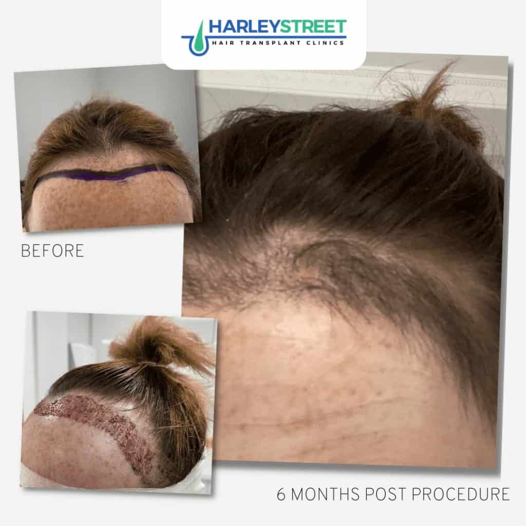 FUE-Female-Hair-Transplant-Before-and-After-hairline-lowering