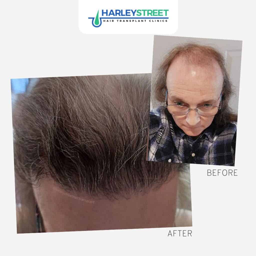 DHI Hair Transplant in Turkey Benefits  Costs