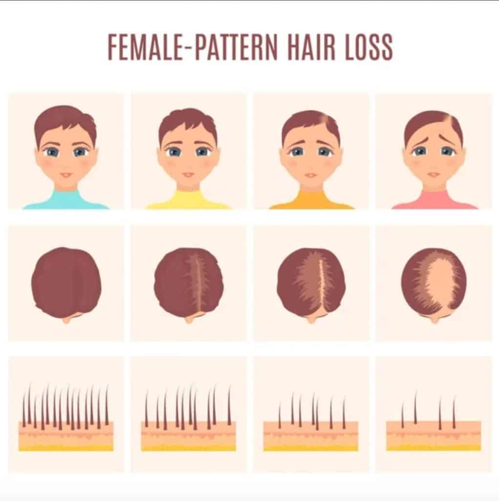 Womens Hair Loss 4 Types 11 Causes  6 Treatments  SkinKraft