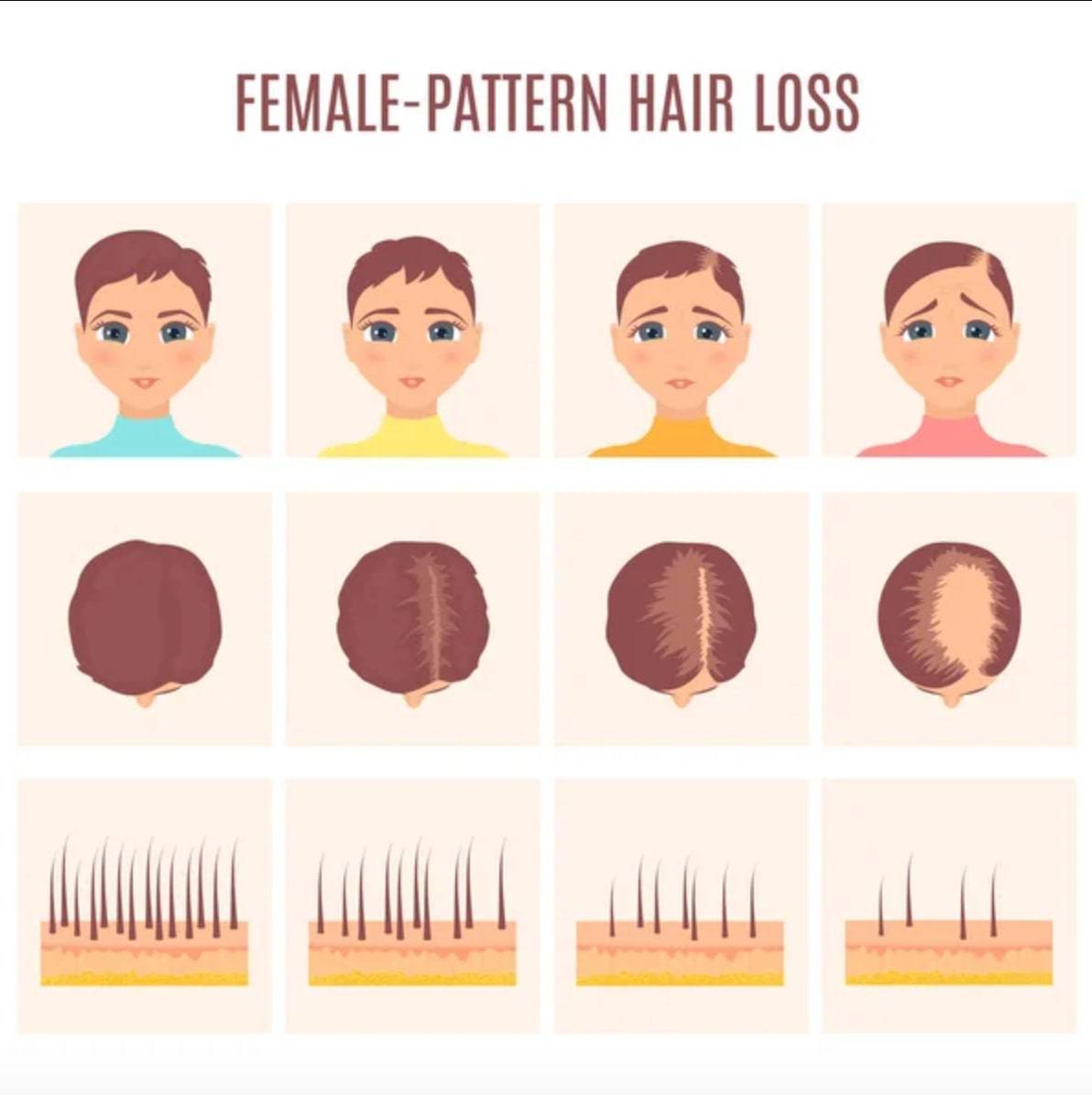 Sixty five years female with frontal hair loss. | Download Scientific  Diagram