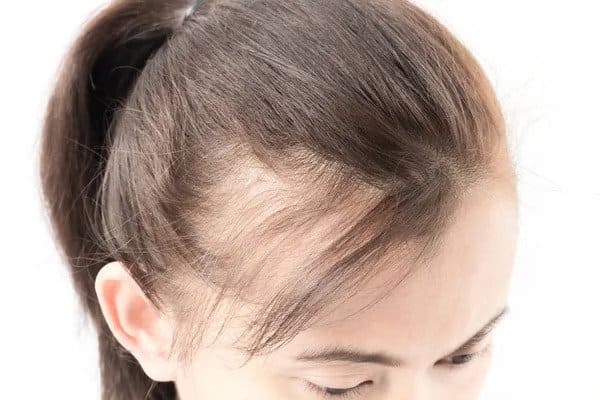 Microneedling for female pattern hair loss: case report and  histopathological changes