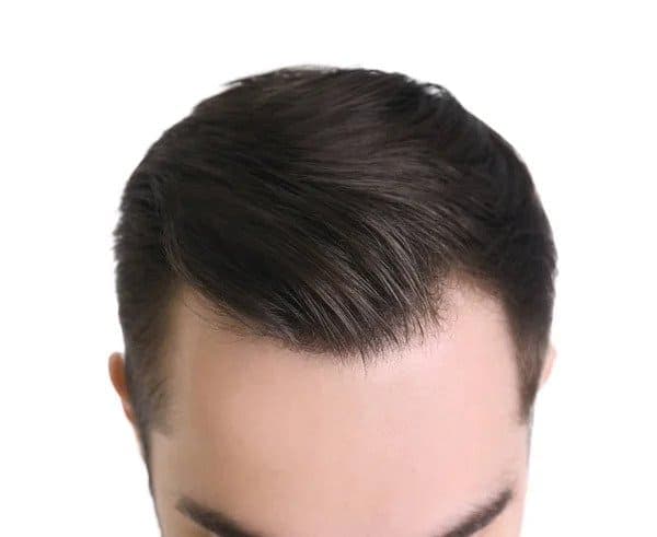 M shape Hairline - What You Can Do?