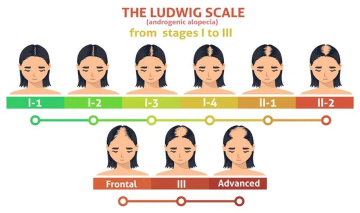 Ludwig's Scale for Women - Use Ludwigs Scale Chart For Hair Loss